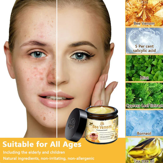 Before and after comparison of woman’s face showing clear skin using bee venom face cream by Trending Height