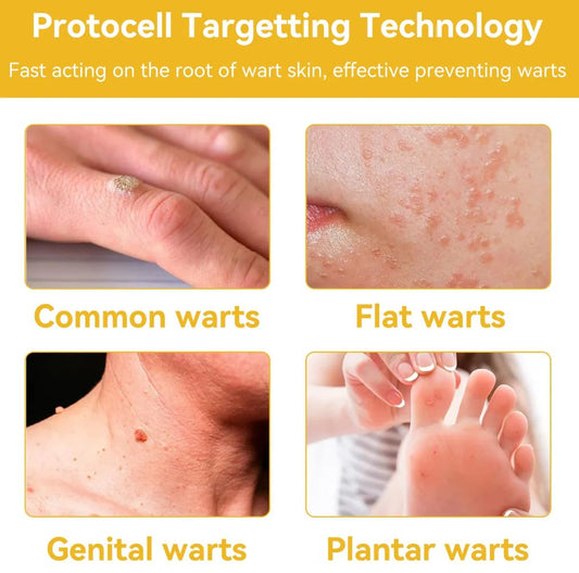 Images showing common, flat, genital, and plantar warts treated with bee venom face cream from Trending Height