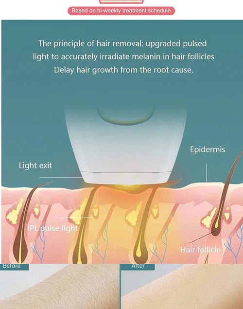 Diagram showing IPL pulse light hair removal process targeting hair follicles for best laser hair remover for sensitive skin